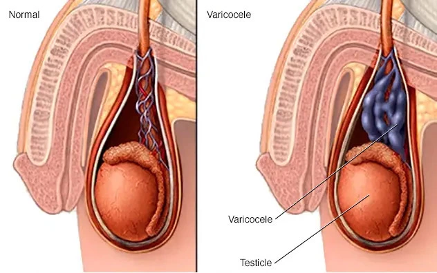 varicocele