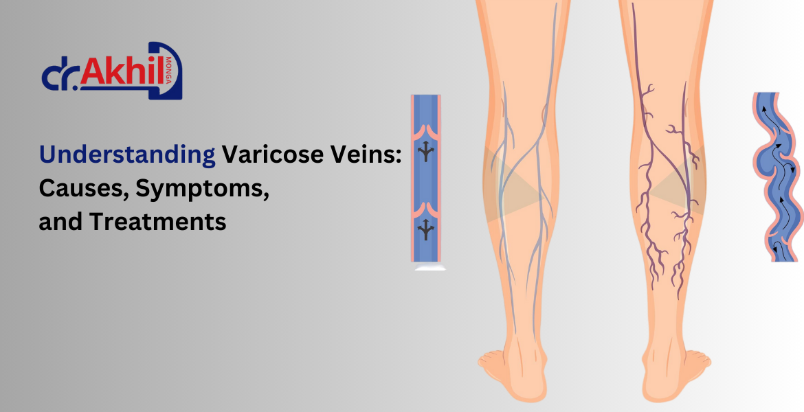 varicose-veins