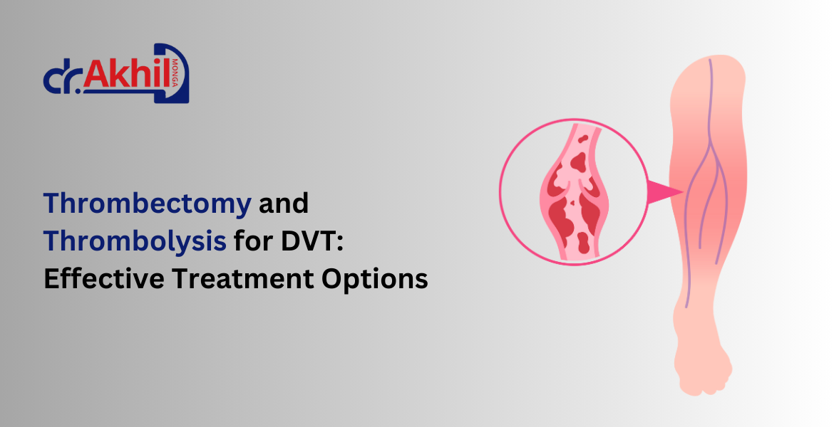 thrombectomy-and-thrombolysis-for-dvt-effective-treatment-options